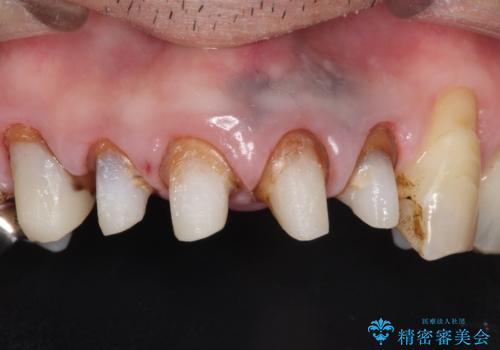 上の前歯の根元が黒い 根の治療を含めたセラミック再治療の治療後