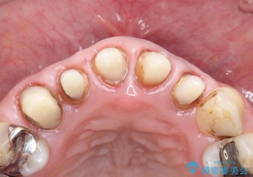 上の前歯の根元が黒い 根の治療を含めたセラミック再治療の治療中