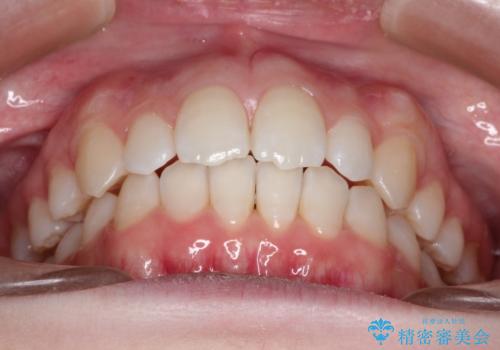 インビザラインでデコボコを目立たず矯正の治療後