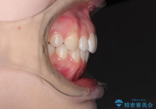 インビザラインでデコボコを目立たず矯正の治療後