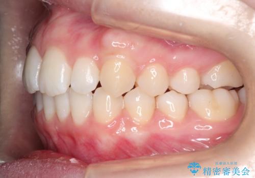 インビザラインでデコボコを目立たず矯正の治療後