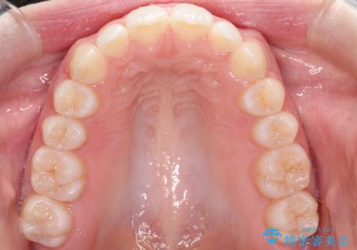 インビザラインでデコボコを目立たず矯正の治療後