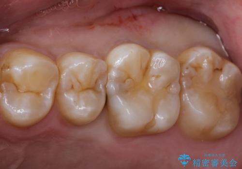 むし歯発見!e-max インレー(プレス)の症例 治療前