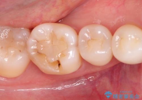 治療したむし歯の再治療。セラミックにしたい!の治療前