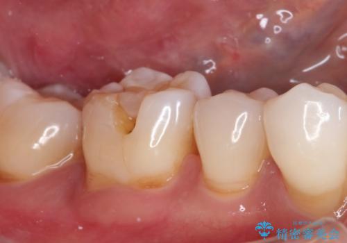 治療したむし歯の再治療。セラミックにしたい!の治療前