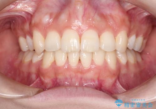 前歯のガタガタと出っ歯が気になる　ハーフリンガルによる抜歯矯正の治療後