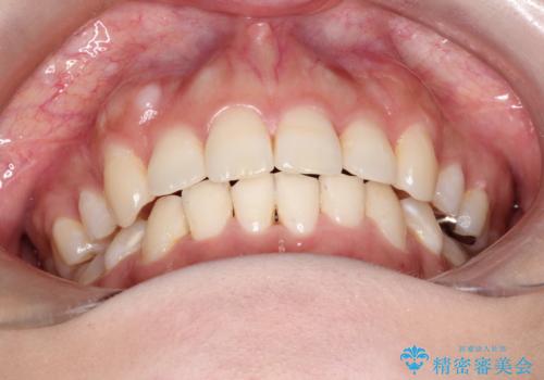 前歯のガタガタと出っ歯が気になる ハーフリンガルによる抜歯矯正の治療後