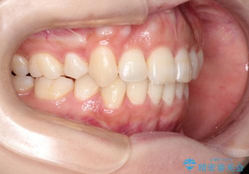 前歯のガタガタと出っ歯が気になる　ハーフリンガルによる抜歯矯正の症例 治療後