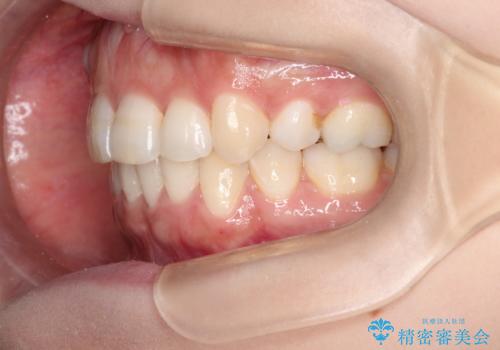 前歯のガタガタと出っ歯が気になる　ハーフリンガルによる抜歯矯正の治療後