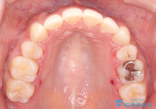 前歯のガタガタと出っ歯が気になる ハーフリンガルによる抜歯矯正の治療後