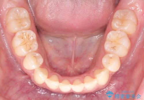 前歯のガタガタと出っ歯が気になる ハーフリンガルによる抜歯矯正の治療後