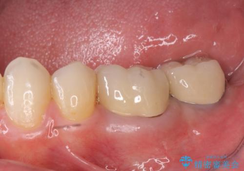 不適合ブリッジの除去  インプラントによる咬合再構成の症例 治療後