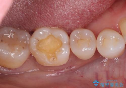 治療したむし歯の再治療。セラミックにしたい!の治療中