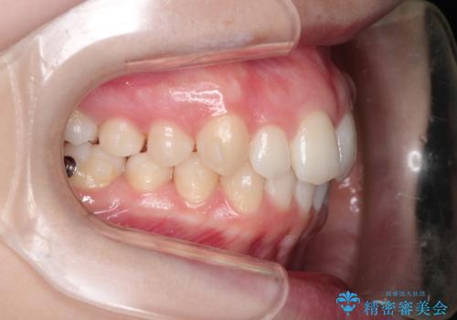 インビザラインでデコボコを目立たず矯正の治療中