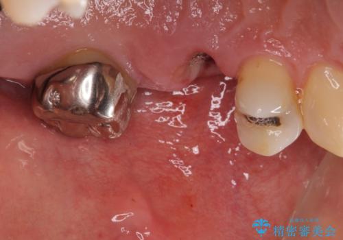 部分矯正を併用した奥歯のインプラント補綴治療の治療前
