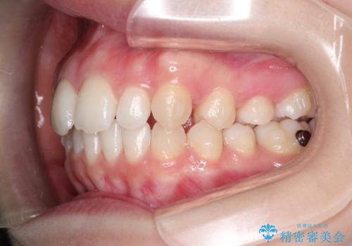 インビザラインでデコボコを目立たず矯正の治療中