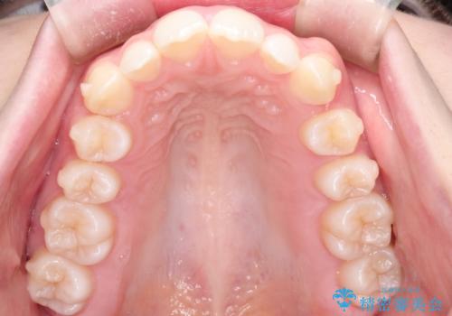 インビザラインでデコボコを目立たず矯正の治療中