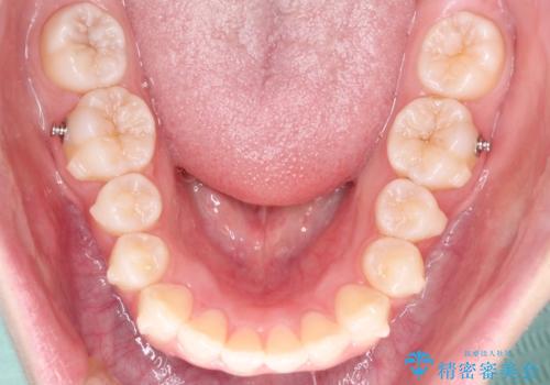 インビザラインでデコボコを目立たず矯正の治療中