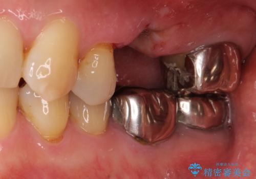 部分矯正を併用した奥歯のインプラント補綴治療の症例 治療前