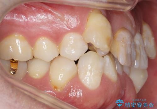 奥に引っ込んでいる歯をセラミックでかぶせたい 補綴前矯正 50代男性の治療前