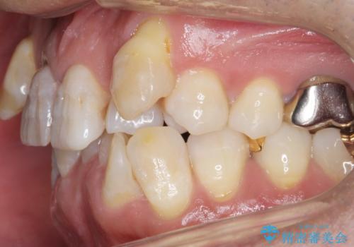奥に引っ込んでいる歯をセラミックでかぶせたい 補綴前矯正 50代男性の治療前