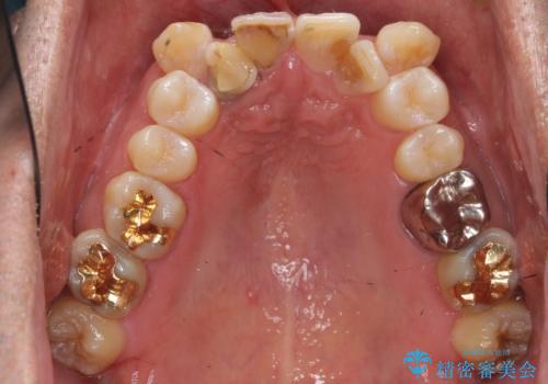 奥に引っ込んでいる歯をセラミックでかぶせたい 補綴前矯正 50代男性の治療前