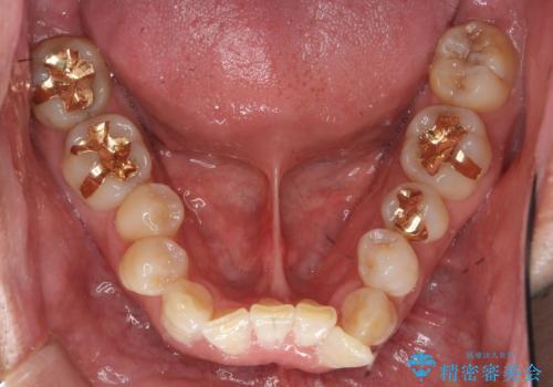 奥に引っ込んでいる歯をセラミックでかぶせたい 補綴前矯正 50代男性の治療前