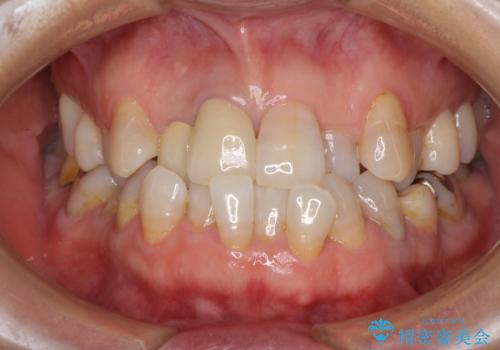 変色した前歯のオールセラミック治療の治療後