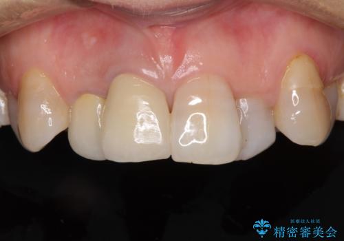 変色した前歯のオールセラミック治療の症例 治療後