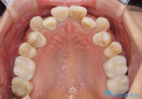 変色した前歯のオールセラミック治療の治療後
