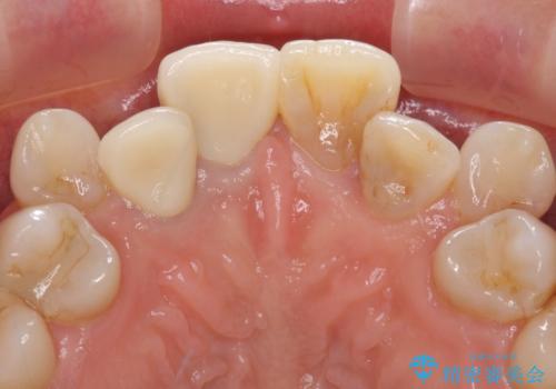 変色した前歯のオールセラミック治療の治療後