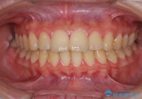 口元が出てるの気になる、引っ込めたい ワイヤーによる抜歯矯正で横顔の改善の治療前