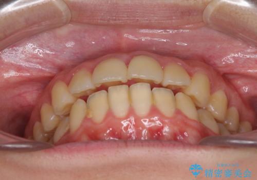 口元が出てるの気になる、引っ込めたい ワイヤーによる抜歯矯正で横顔の改善の治療前