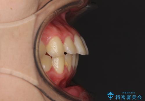 口元が出てるの気になる、引っ込めたい ワイヤーによる抜歯矯正で横顔の改善の治療前