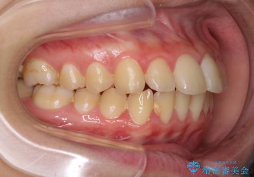 口元が出てるの気になる、引っ込めたい ワイヤーによる抜歯矯正で横顔の改善の治療前