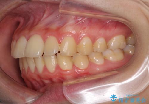 口元が出てるの気になる、引っ込めたい ワイヤーによる抜歯矯正で横顔の改善の治療前