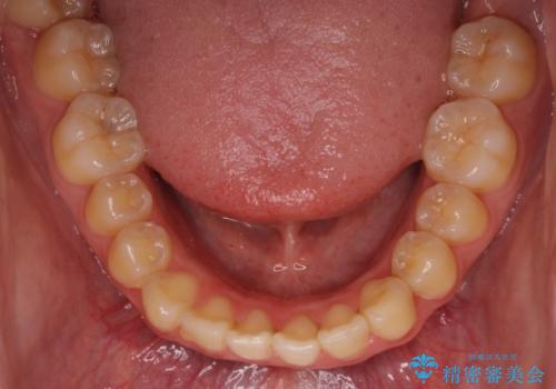 口元が出てるの気になる、引っ込めたい ワイヤーによる抜歯矯正で横顔の改善の治療前