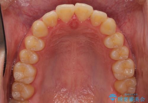 口元が出てるの気になる、引っ込めたい ワイヤーによる抜歯矯正で横顔の改善の治療前