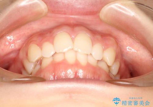 インビザラインでデコボコを目立たず矯正の治療前