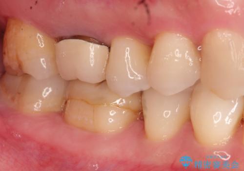 以前治療歯の中が虫歯になっている気がする セラミッククラウンによる再補綴の治療前