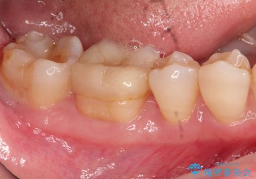 以前治療歯の中が虫歯になっている気がする　セラミッククラウンによる再補綴の治療前