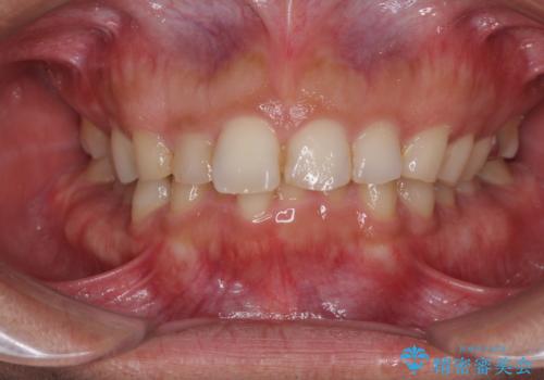 インビザライン矯正とインプラント補綴　深い咬み合わせと奥歯の欠損治療の症例 治療前