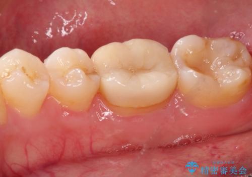 以前治療歯の中が虫歯になっている気がする　セラミッククラウンによる再補綴の治療前