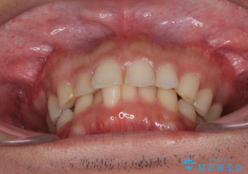 インビザライン矯正とインプラント補綴 深い咬み合わせと奥歯の欠損治療の治療前