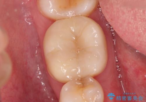 以前治療歯の中が虫歯になっている気がする セラミッククラウンによる再補綴の治療前