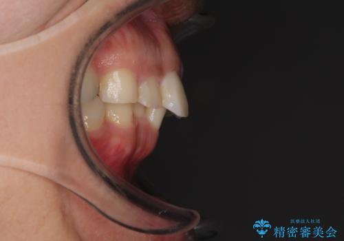 インビザライン矯正とインプラント補綴 深い咬み合わせと奥歯の欠損治療の治療前