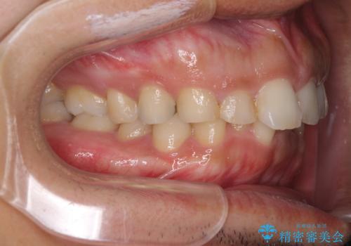 インビザライン矯正とインプラント補綴 深い咬み合わせと奥歯の欠損治療の治療前