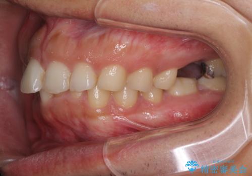 インビザライン矯正とインプラント補綴 深い咬み合わせと奥歯の欠損治療の治療前