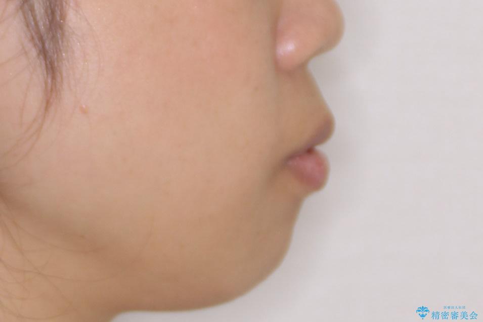 口元が出てるの気になる、引っ込めたい ワイヤーによる抜歯矯正で横顔の改善の治療前(顔貌)