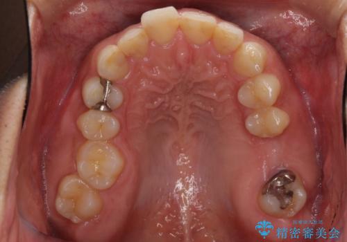 インビザライン矯正とインプラント補綴 深い咬み合わせと奥歯の欠損治療の治療前